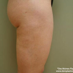 Liposuction before and after photos