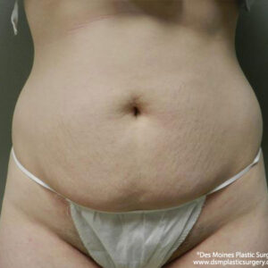 Tummy Tuck before and after photos