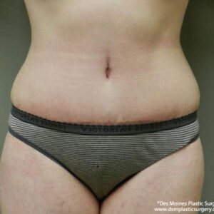 Tummy Tuck before and after photos