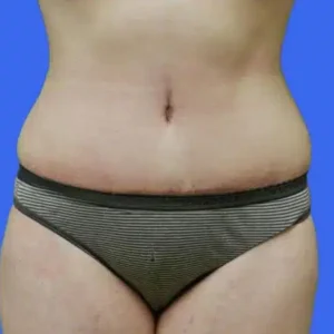 Tummy Tuck before and after photos Tummy Tuck before and after photos