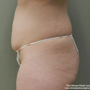 Tummy Tuck before and after photos