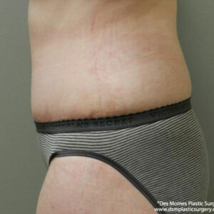 Tummy Tuck before and after photos