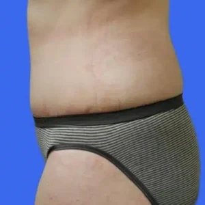 Tummy Tuck before and after photos Tummy Tuck before and after photos
