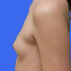 Breast Augmentation before and after photos Breast Augmentation before and after photos