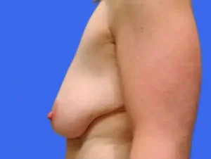 Breast Lift before and after photos Breast Lift before and after photos