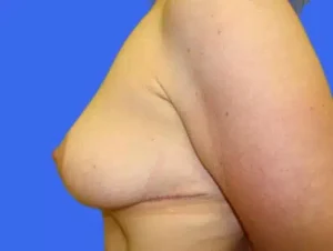 Breast Lift before and after photos Breast Lift before and after photos