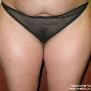 Liposuction before and after photos