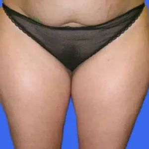 Liposuction before and after photos Liposuction before and after photos
