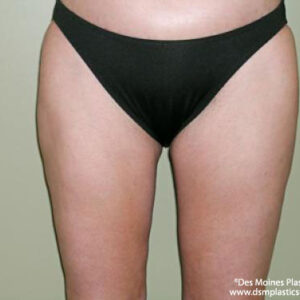 Liposuction before and after photos