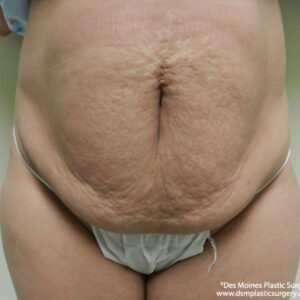 Tummy Tuck before and after photos