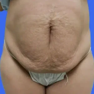 Tummy Tuck before and after photos Tummy Tuck before and after photos