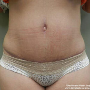 Tummy Tuck before and after photos