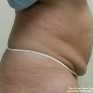 Tummy Tuck before and after photos