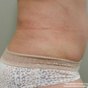 Tummy Tuck before and after photos