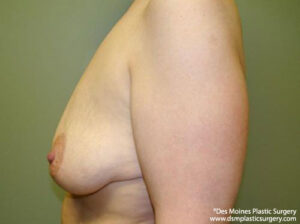 Breast Lift before and after photos