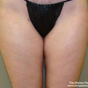 Liposuction before and after photos