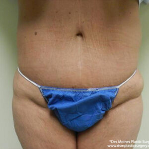 Tummy Tuck before and after photos