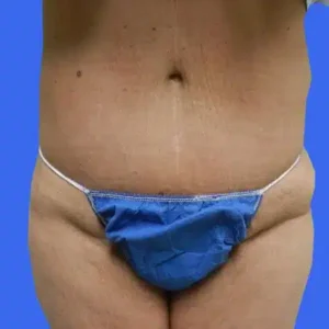 Tummy Tuck before and after photos Tummy Tuck before and after photos