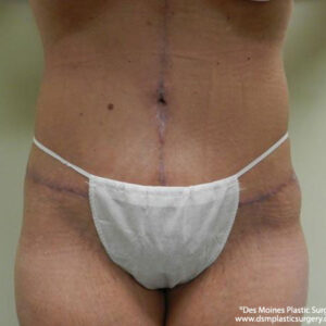 Tummy Tuck before and after photos
