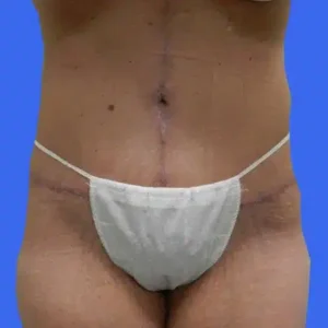 Tummy Tuck before and after photos Tummy Tuck before and after photos