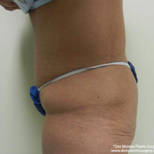 Tummy Tuck before and after photos