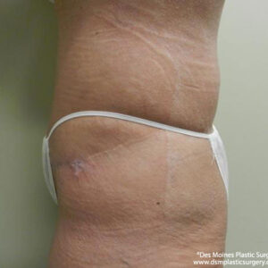 Tummy Tuck before and after photos