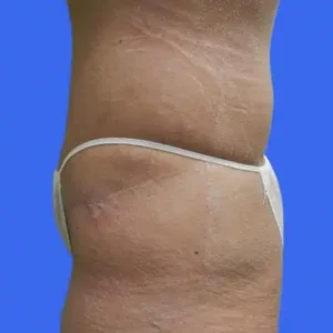 Tummy Tuck before and after photos Tummy Tuck before and after photos