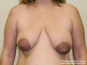 Breast Lift before and after photos