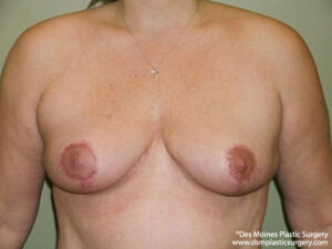 Breast Lift before and after photos