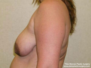 Breast Lift before and after photos