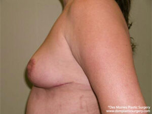 Breast Lift before and after photos