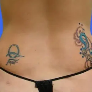 Liposuction before and after photos Liposuction before and after photos