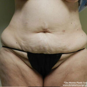 Tummy Tuck before and after photos