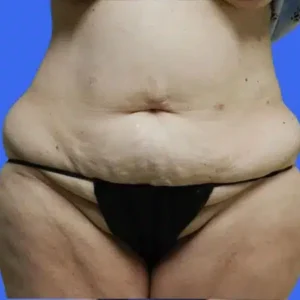 Tummy Tuck before and after photos Tummy Tuck before and after photos