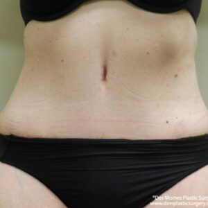 Tummy Tuck before and after photos
