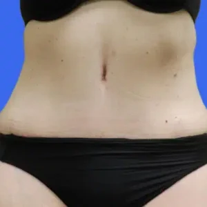 Tummy Tuck before and after photos Tummy Tuck before and after photos