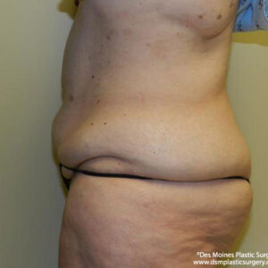 Tummy Tuck before and after photos