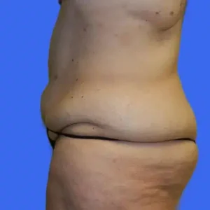 Tummy Tuck before and after photos Tummy Tuck before and after photos