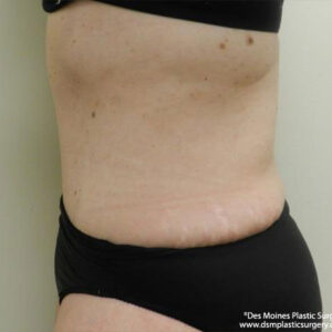 Tummy Tuck before and after photos