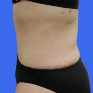 Tummy Tuck before and after photos Tummy Tuck before and after photos