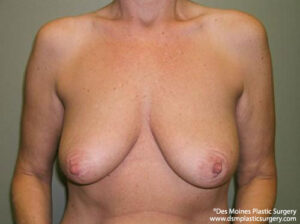 Breast Lift before and after photos