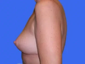 Breast Lift before and after photos Breast Lift before and after photos