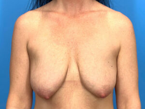 Breast Lift before and after photos