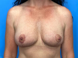 Breast Lift before and after photos