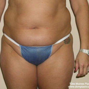 Liposuction before and after photos