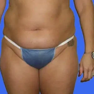 Liposuction before and after photos Liposuction before and after photos