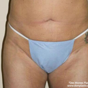 Liposuction before and after photos