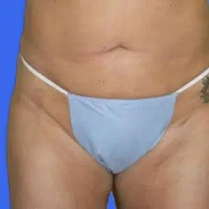 Liposuction before and after photos Liposuction before and after photos