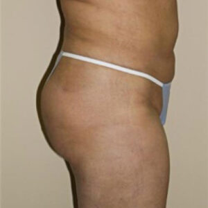 Liposuction before and after photos