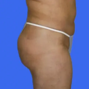 Liposuction before and after photos Liposuction before and after photos